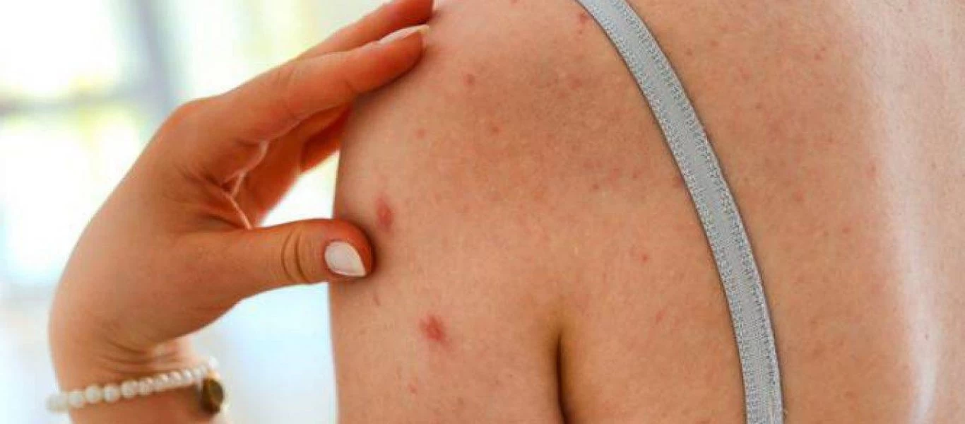 Πώς θα προστατευτείτε από τον καρκίνο του δέρματος